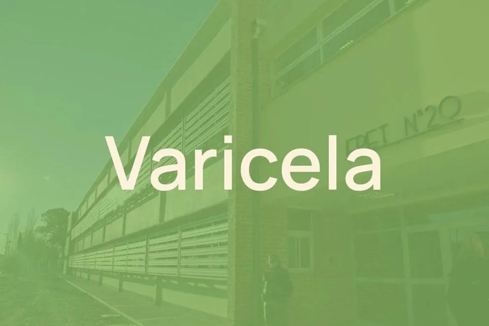 Salud y Educación monitorean dos brotes de varicela en dos escuelas de Neuquén capital